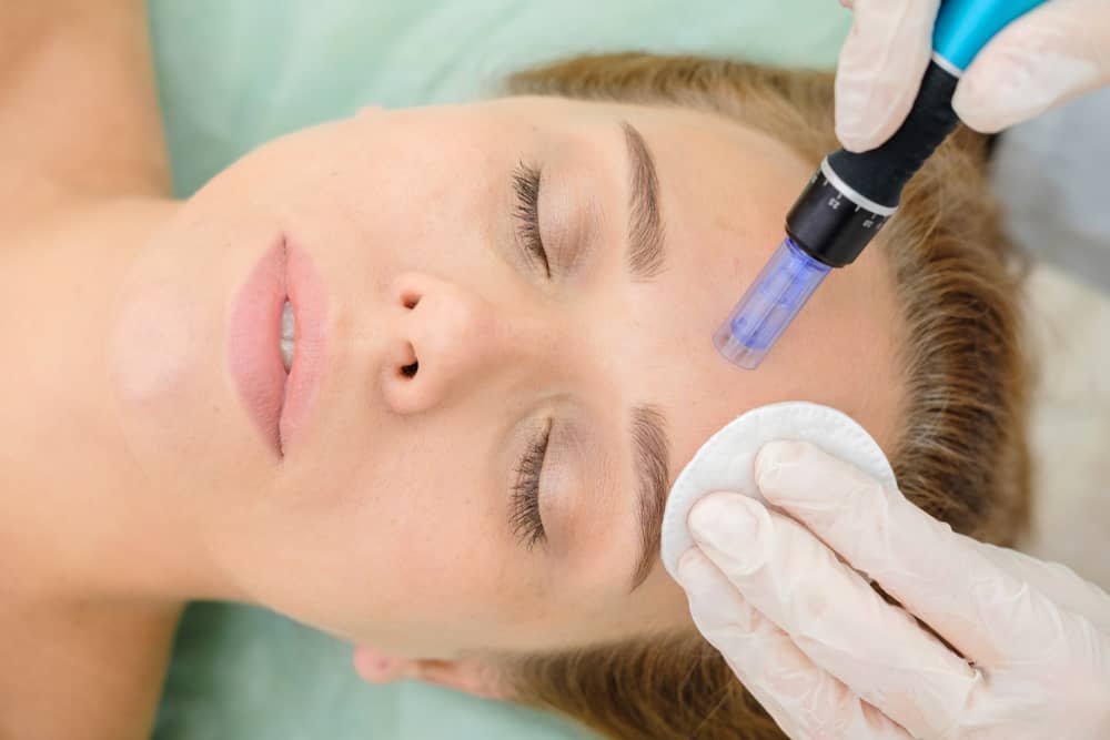 Microneedling + Radio-Frequency Treatment